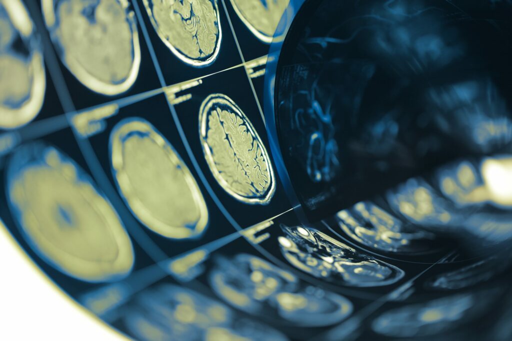 Brain Xray